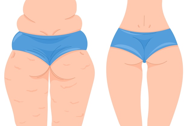 Vetor ilustração vetorial colorida antes e depois de perder peso vista traseira feminina com e sem celulite nádegas femininas em uma calcinha azul