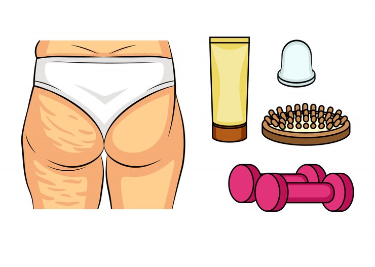 Vetor ilustração vetorial de cor antes e depois de problemas de celulite. quadris femininos vista traseira. depósitos de gordura nas nádegas femininas. maneiras de combater a celulite. ícones de infográficos esfregam, massagem, fitness.