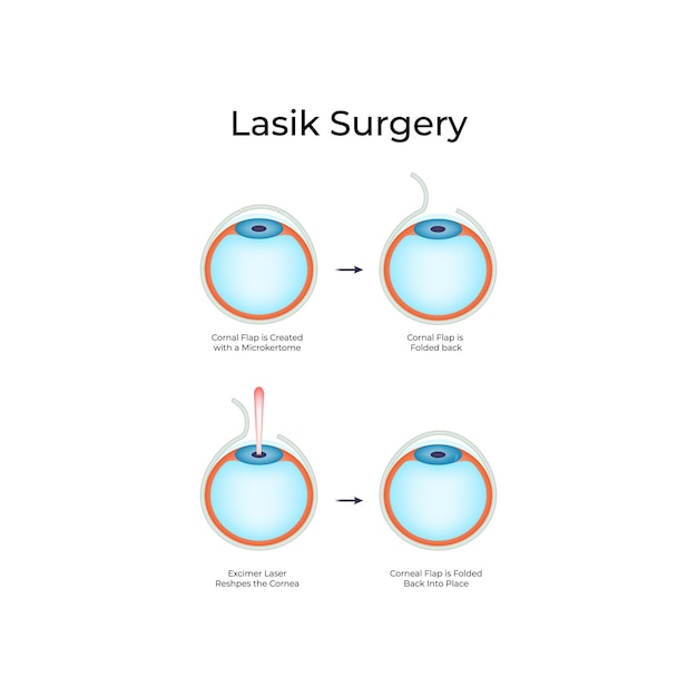 Ilustração vetorial do procedimento de cirurgia Lasik