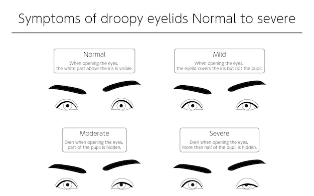 Vetor ilustrações médicas sintomas de ptose normal a grave