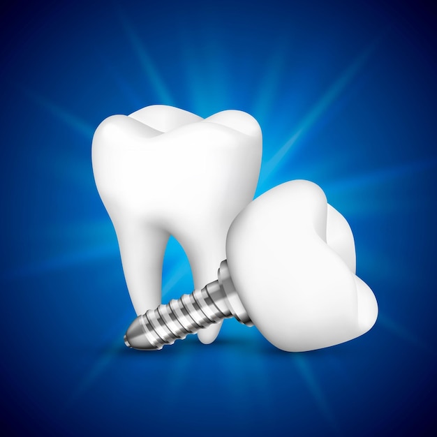 Implante de dente em um fundo azul. ilustração vetorial