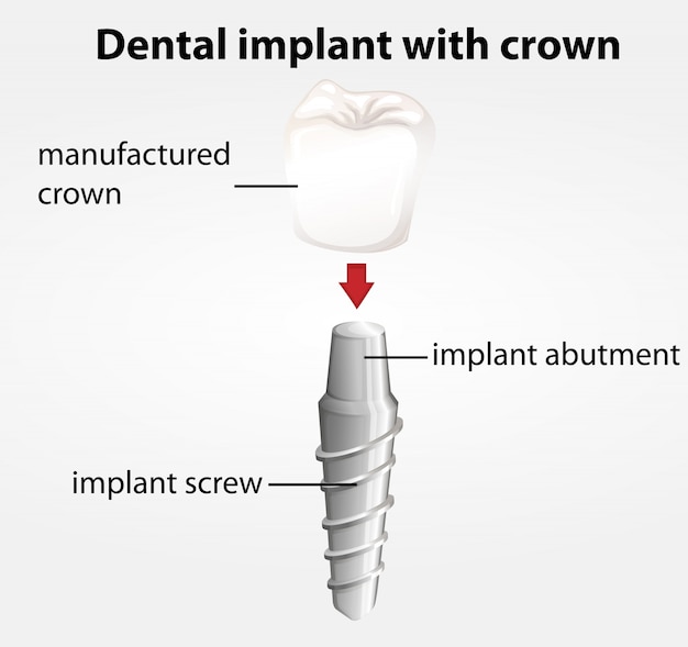 Vetor implante dentário com coroa