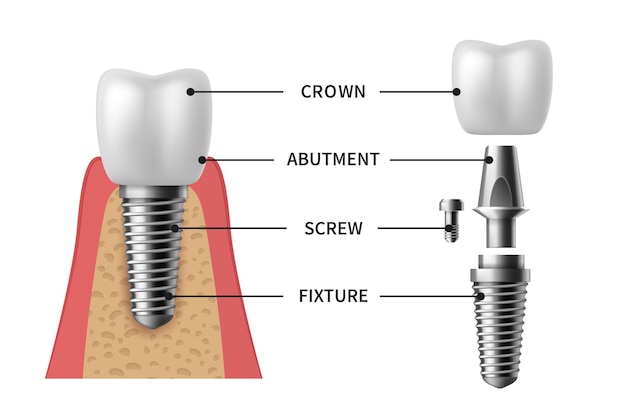 Implante dentário. Coroa de modelos pictóricos de estrutura de implante realista. Abutment, dentadura de parafuso para implante ortodôntico de dentes. Conjunto de vetores de conceito de clínica de estomatologia