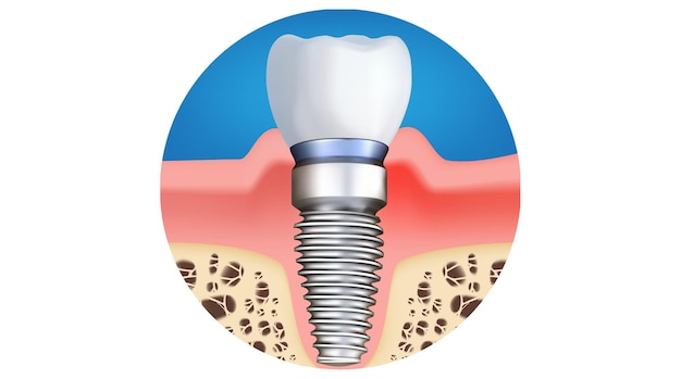 Vetor implante dentário ilustração vetorial realista
