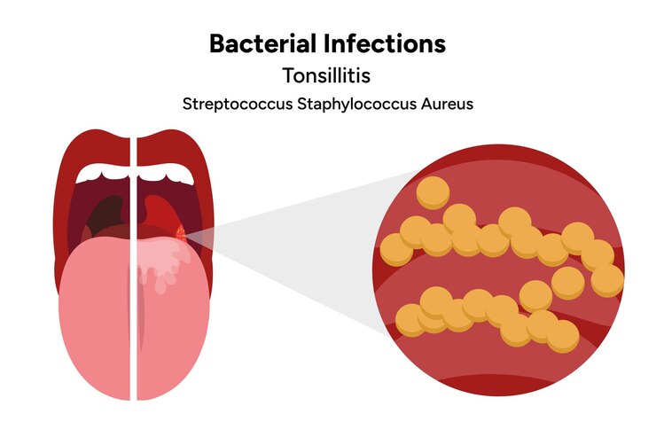 Vetor infecção bacteriana amigdalite