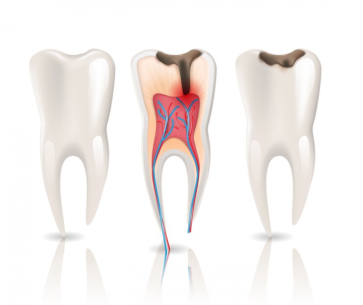 Vetor infecção por cáries no esmalte e dente de saúde