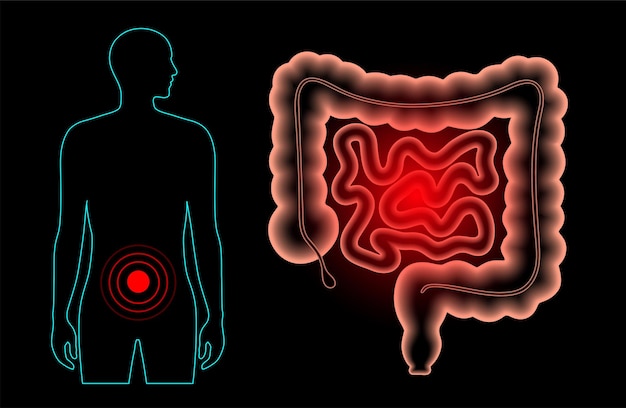 Inflamação e dor no intestino humano. doença inflamatória intestinal, colite ulcerosa, infecções gastrointestinais ou câncer colorretal. exame médico de ilustração vetorial 3d de órgãos internos