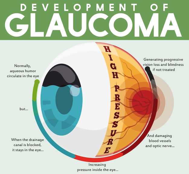 Vetor infográfico com o desenvolvimento da doença de glaucoma não tratada