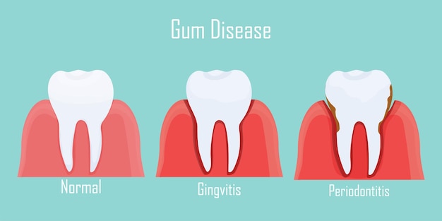 Infográfico de dentes doença gengival estágios de gengivite