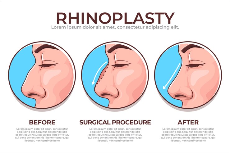Vetor infográfico de rinoplastia desenhado à mão