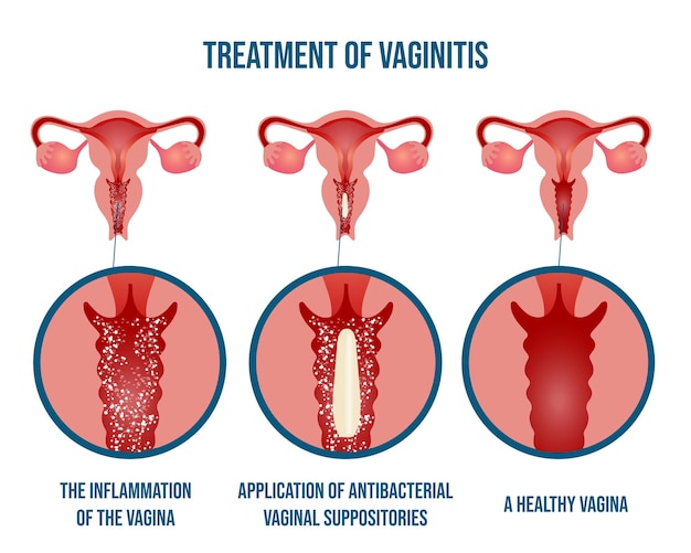 Vetor infográfico do tratamento da vaginite em ilustração vetorial