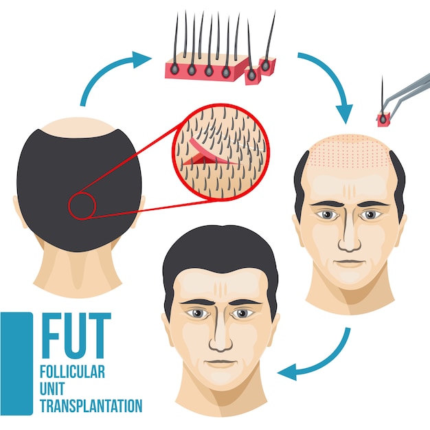 Infográfico médico de tratamento de perda de cabelo masculino