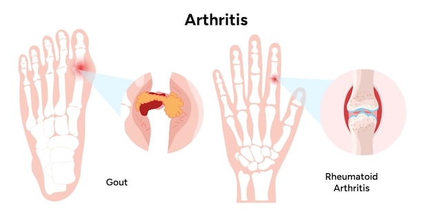 Vetor infográfico médico e informação artrite da gota no pé