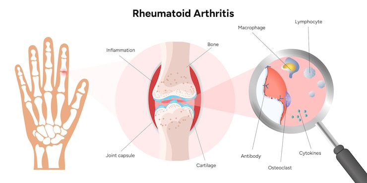 Vetor infográfico médico sobre artrite reumatoide