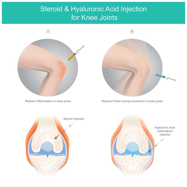Injeção de esteróide e ácido hialurônico para articulações do joelho.