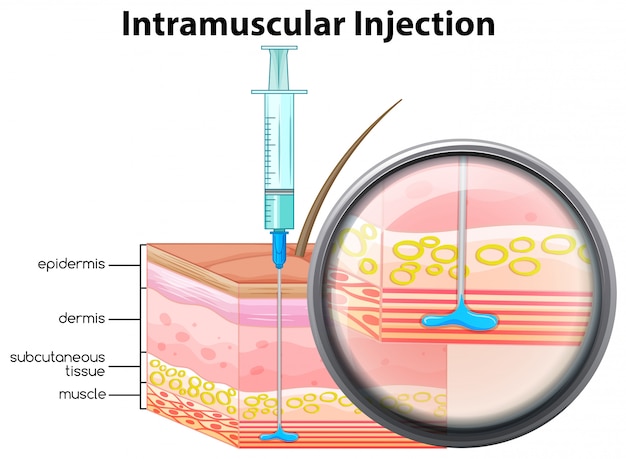 Injeção intramuscular da pele humana