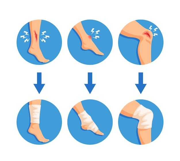 Vetor leg bandaging professional envolve a perna de um paciente em uma bandagem especializada para apoiar a cicatrização e prevenir mais lesões