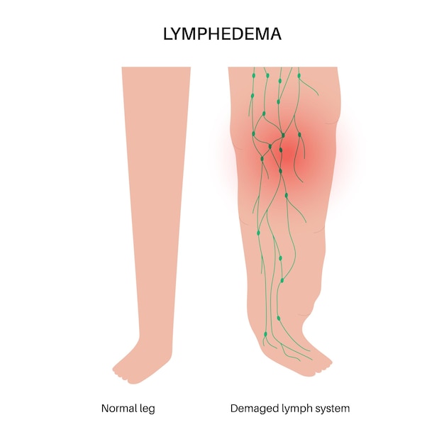 Vetor linfedema inchaço nas pernas