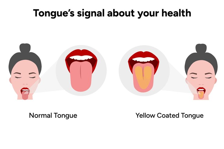 Vetor língua com revestimento normal e amarelo
