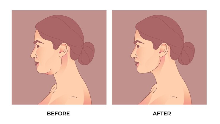 Vetor lipoaspiração de queixo duplo. antes e depois de braquioplastia, lipoaspiração ou cirurgia plástica