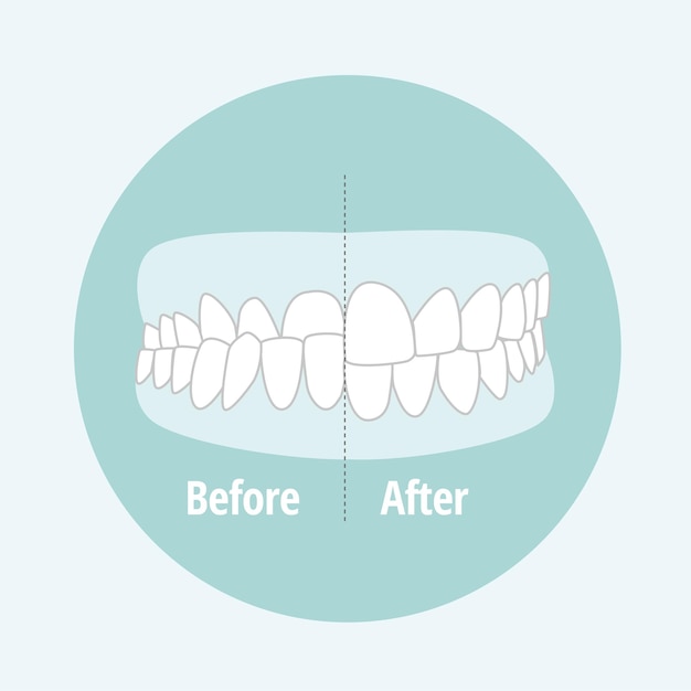 Maloclusão Underbite Ilustração vetorial de problema dentário Conceito de atendimento odontológico