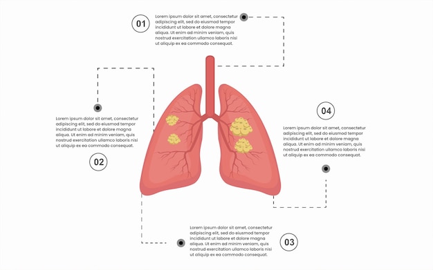 Modelo de infográfico criativo para sinais de doenças pulmonares com 4 opções, peças, etapas ou pontos.