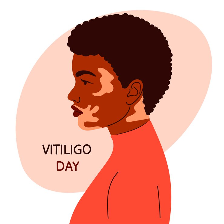 Mulher afro-americana com vitiligo.girl no perfil. estilo cartoon