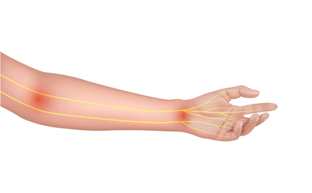 Vetor nervo do braço sobre a anatomia humana amarela. em um fundo branco. conceitos médicos.