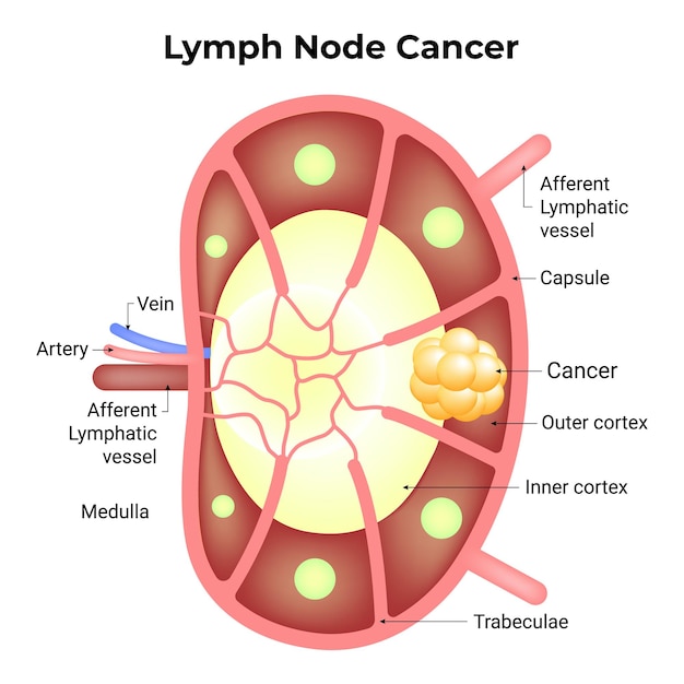 Vetor nódulo linfático câncer veia artéria medula vaso linfático aferente cápsula amp exterior córtex interno