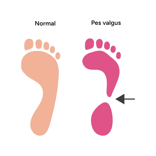 Vetor normal e pes valgus