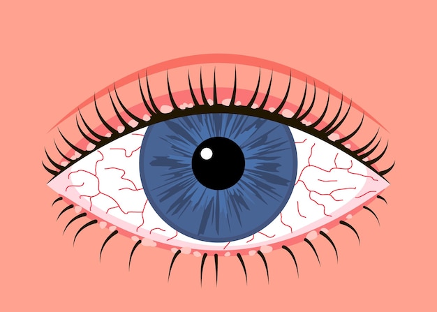 olho humano doente inflamado sintoma de alergia de blefarite veias vermelhas doença ocular conjuntivite alérgica