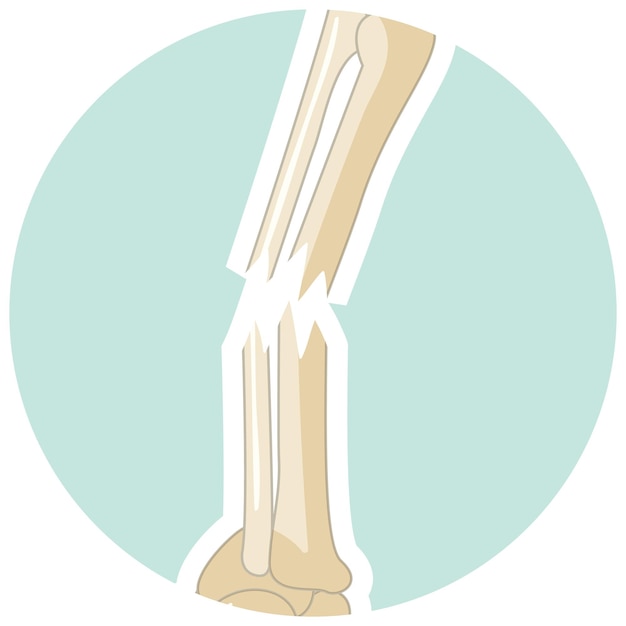 Vetor osso humano quebrado em estilo cartoon
