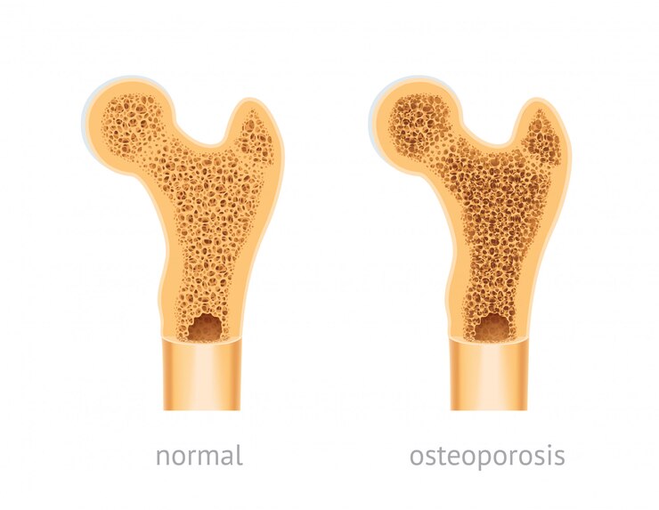 Osso humano saudável e com osteoporose