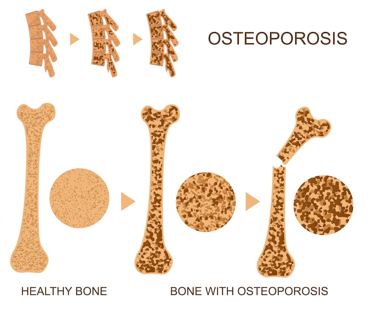 Vetor osteoporose infografia óssea cartão conceitual poster saúde humana médica ilustração vetorial de fratura saudável e com doença