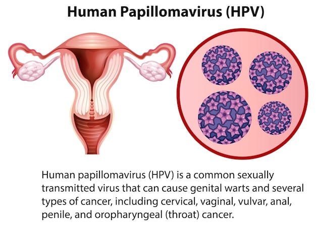 Vetor papilomavírus humano com explicação