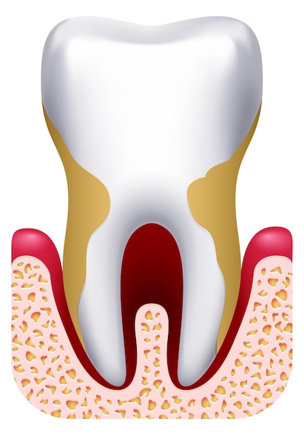 Vetor parodontite desenho tratamento em clínica dentária doença dentária