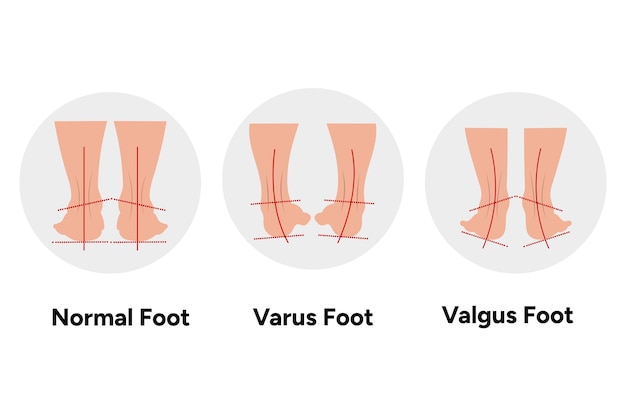 Vetor pés valgus e varus normais