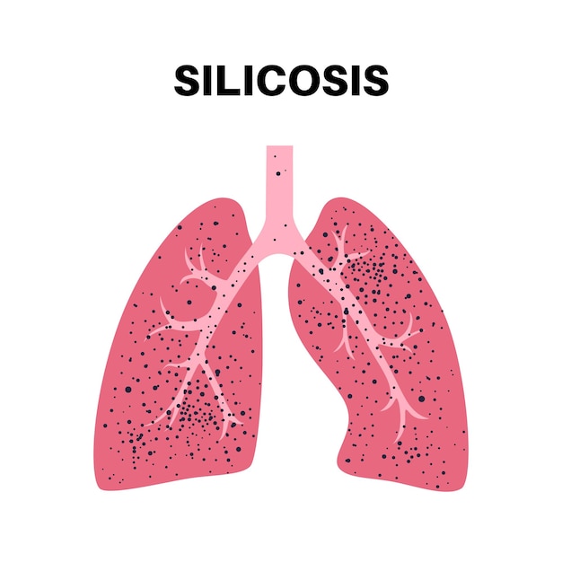 Vetor pó de silicose no pulmão