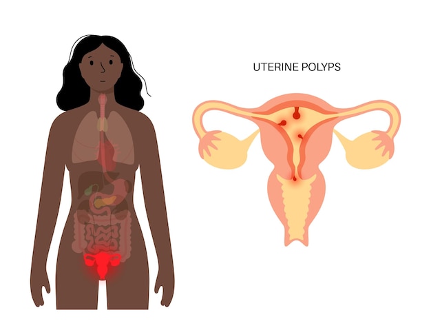 Vetor pólipos uterinos