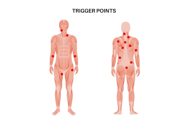 Vetor pontos de gatilho miofasciais