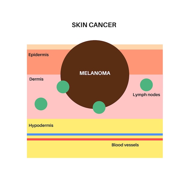 Vetor pôster gráfico de melanoma