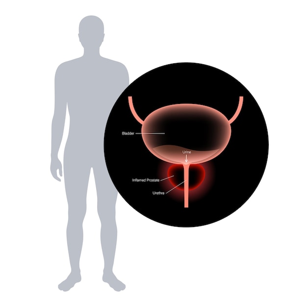 Problema de inflamação da prostatite