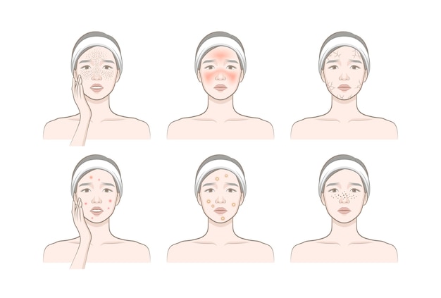 Problemas cosméticos de pele_mulher com sardas, blush, secura, pápula, pastula, cravo
