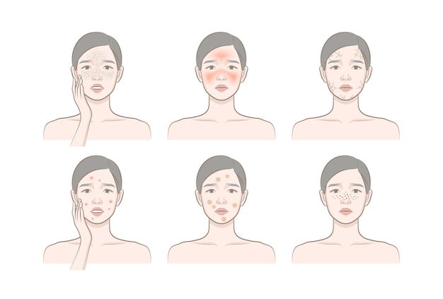 Problemas cosméticos de pele_mulher com sardas, blush, secura, pápula, pastula, cravo