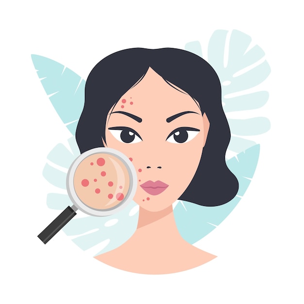 Problemas de pele de acne mulher segurando lupa para olhar acne cística em sua ilustração vetorial facial