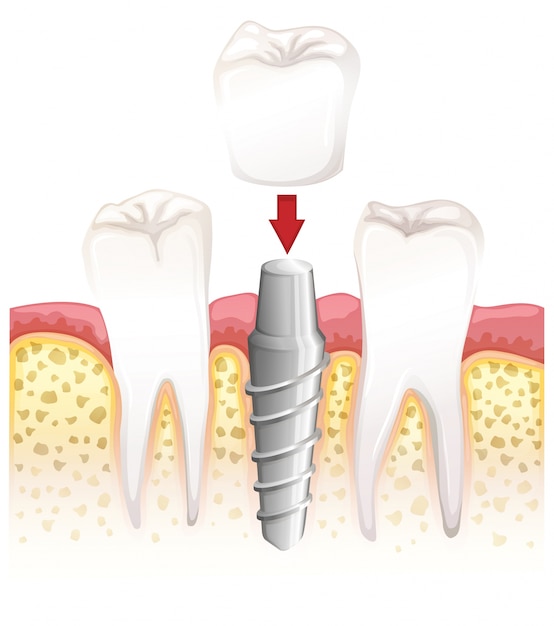 Vetor procedimento da coroa dentária