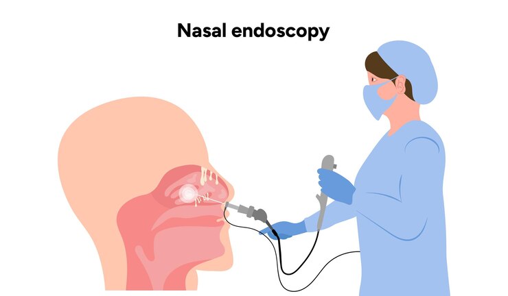 Vetor procedimento de endoscopia nasal passagens nasais e sinusais com médico tubo otolaryng com luz de câmera