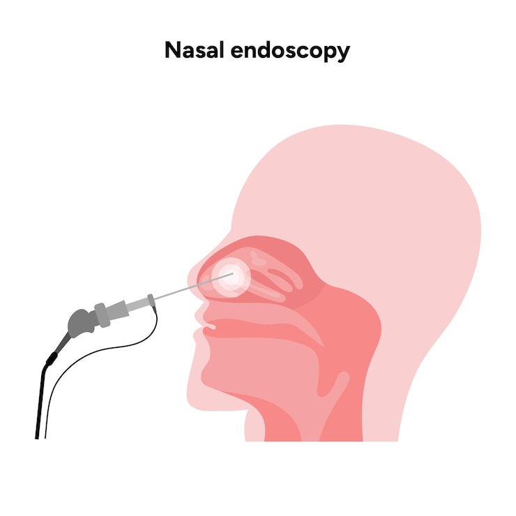 Vetor procedimento de endoscopia nasal passagens nasais e sinusais tubo flexível com câmara e luz