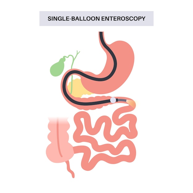 Procedimento de enteroscopia com balão único Visualização da técnica não cirúrgica do intestino delgado Problema no trato gastrointestinal Biópsia remoção de pólipos terapia de sangramento ou colocação de stent vetor plano