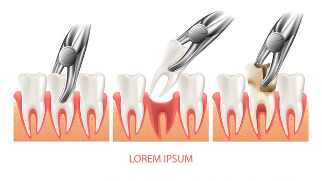 Procedimento de extração de dente decadente